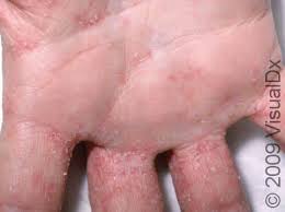 Image result for scabies human bites