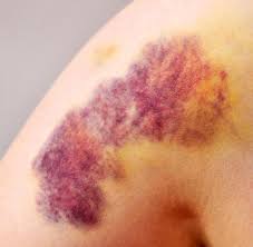 Blutgerinnsel können oberflächlich sein (sie entstehen dabei direkt in den venen unter der haut) oder tief (tiefe venöse thrombose). Blutung Wann Sie Mit Einem Blauen Fleck Zum Arzt Mussen Welt