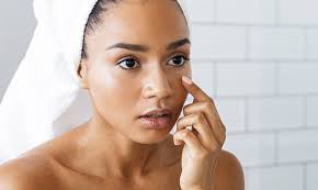 Blackheads or Sebaceous Filaments