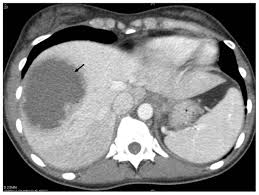 Image result for Liver Abscess