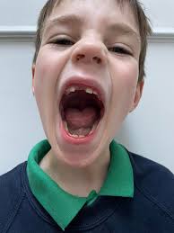 Hi my son is 12 he's autism and afrid, he was diagnosed with a post natural  drip ( the tube you have in your nose to your throat is too narrow) so