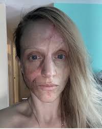 In September 2019, Shelley Puchalsky tripped over her dog, landing  headfirst in the dirt. The impact led to a skull infection and severe skin  deterioration. Although she initially received 40 stitches, they