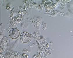 Image result for Cyclospora