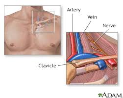 Thoracic Outlet Syndrome Information Mount Sinai New York