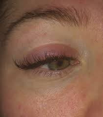 The presenting signs of eyelid skin cancers are highly variable. Allergic Reactions To Eyelash Extensions Whip Lash