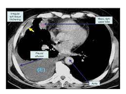 It is associated with significant morbidity and mortality. Pleural Effusion Dr Mahesh