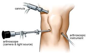 Procedure For Arthroscopic Knee Surgery Arthroscopic Knee Surgery Knee Surgery Knee Arthroscopy