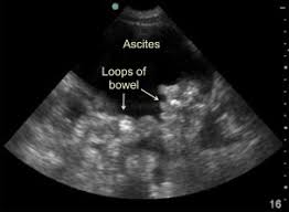 Image result for Shifting Dullness Test