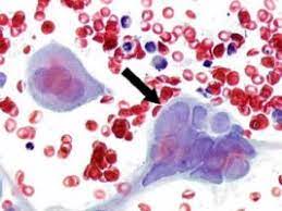 Herpes Simplex Virus Cistite Info Aps