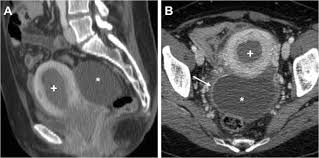 Symptoms associated with ct scan of the uterus. Cross Sectional Imaging Of Acute Gynaecologic Disorders Ct And Mri Findings With Differential Diagnosis Part Ii Uterine Emergencies And Pelvic Inflammatory Disease Insights Into Imaging Full Text
