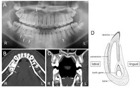 Charting Supernumerary Teeth | Dentrix Ascend