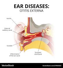 Image result for Acute Otitis Externa