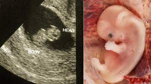 Zum ende dieser woche werden die wichtigsten organe des babys vollständig. 9 Ssw 9 Schwangerschaftswoche Dein Baby Hat Jetzt Mund Lippen Hallo Eltern
