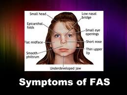 Top Symptoms Of Fetal Alcohol Spectrum Disorders In 2020 Fetal Alcohol Fetal Alcohol Syndrome Foetal Alcohol Syndrome