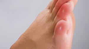 Image result for Chilblains
