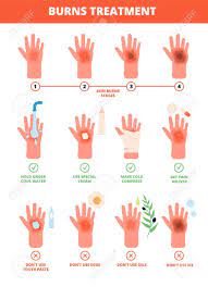 Doctors evaluate burns by degree. Skin Burn Burned Hand Treating Protection Burns First Aid Royalty Free Cliparts Vectors And Stock Illustration Image 141281722