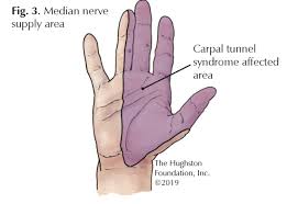 Carpal tunnel syndrome (cts) is a peripheral neuropathy caused by chronic or acute compression of the median nerve by the transverse carpal ligament. Carpal Tunnel Syndrome And Chiropractic Treatment