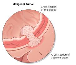 Types of Bladder Cancer | Roswell Park Comprehensive Cancer Center