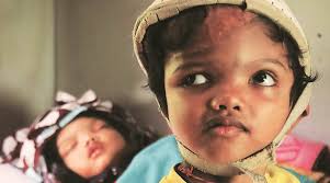 As conjoined twins, lori and george schappell have appeared in a number of television documentaries and talk shows. One In 25 Lakh Two Years After Successful Surgery Odisha Conjoined Twins Leave Aiims India News The Indian Express