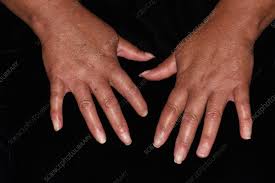 Image result for Connective Tissue Disorder