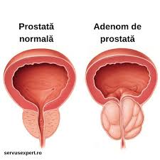 Leacurile noastre fokusin inoltre prostamol interzise persoanelor alergice la prostata: Fokusin Ed Prostamol Adenomul De Prostata Manifestari