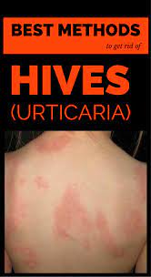 Hives Also Known As Urticaria Is A Dermatological Affection Characterized By Red Spots On The Skin Together Urticaria Chronic Hives Home Remedies For Hives