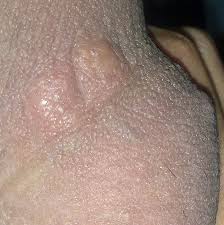 Granos En Pene Y Testiculos 2 768 769 Dermatologo Net