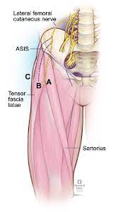 Anterior superior iliac spine (asis) insertion: Branching Pattern Of The Lateral Femoral Cutaneous Nerve In Relation To Download Scientific Diagram