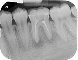 Maybe you would like to learn more about one of these? Twice Failed Root Canal What Now Dentistry