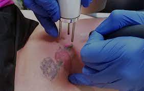 He also said that there are a lot of toxic metals in tattoo ink and its. Laser Tattoo Removal Sacramento Laser Hair Removal Inkoff Me