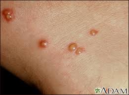 We did not find results for: Chiggers Information Mount Sinai New York