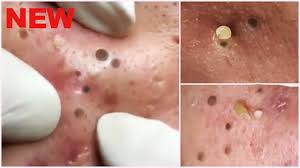 Be sure to keep a check on these pimples, and do not pick or pluck. Deep Blackheads Removal From Cheeks And Nose Best Pimple Popping Videos Youtube