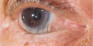 I would like to look under my eyelid but don't know how to flip it. What Is Trichiasis American Academy Of Ophthalmology