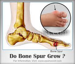 Maybe you would like to learn more about one of these? Do Bone Spurs Grow