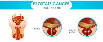 But hearing the words can still be scary. Know Your Predisposition Towards Prostate Cancer With Genetic Testing