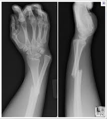 Image result for Fracture Complication