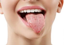 Puntos Rojos En La Lengua Por Que Salen Y Como Se Curan Prodental Santa Cruz
