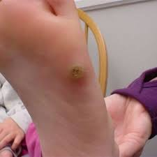 Plantar Wart Home Remedies For Warts Warts Remedy Wart Treatment