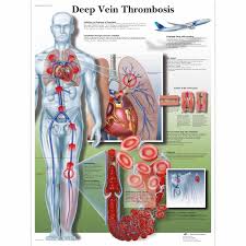 Deep Vein Thrombosis Chart
