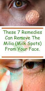 When to see a dermatologist These 7 Remedies Can Remove The Milia Milk Spots From Your Face Milk Spots Skin Care Remedies Warts On Face