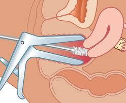 How to decode an abnormal test result. Lakukan Ujian Pap Smear 3 Tahun Sekali Bawangputih