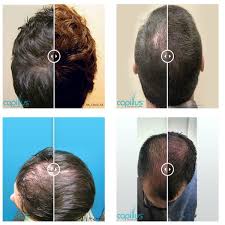 Hair loss often signals a variety of medical problems. Hair Loss Treatment Hair Restoration Willow Health And Aesthetics