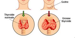 L'hypothyroïdie et l'hyperthyroïdie sont des troubles thyroïdiens très fréquents. Hypo Ou Hyperthyroidie Tout Est Dans La Nature Pas De Maladie Sans Son Remede