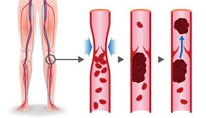 Folgende medikamente werden in der therapie von. Thrombose In Der Schwangerschaft Symptome Und Behandlung