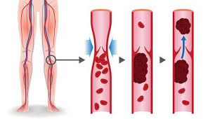 Ich habe da mal ne frage, ab wann genau verspürt man schwangerschaftsanzeichen? Thrombose In Der Schwangerschaft Symptome Und Behandlung