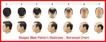 Stages Of Male Female Pattern Baldness Thinscalp Com
