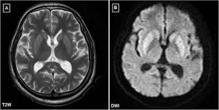 Image result for Progressive Bulbar Paralysis