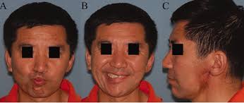 Preliminary results of 125I interstitial brachytherapy for locally  recurrent parotid gland cancer in previously irradiated patients