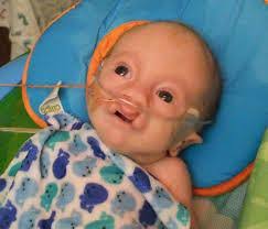 Edwards syndrome is a genetic disorder, in which a person has a third copy of material from chromosome 18, instead of the usual two copies. Edwards Syndrome On Twitter Images Of Trisomy 18 Edwards Syndrome Http T Co Enckqchmw1