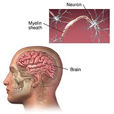 Image result for Multiple Sclerosis